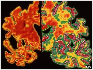 Solda Alzheimer hastalıklı bir beynin kesiti belirgin beyin hücre kaybını gösteriyor